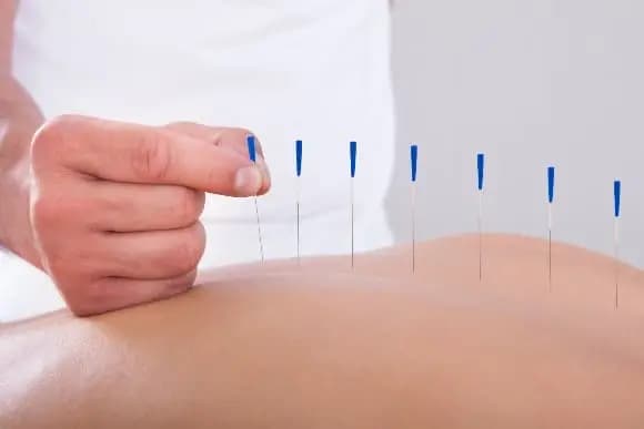Akupunktur mit dünnen Nadeln am Rücken, TCM.