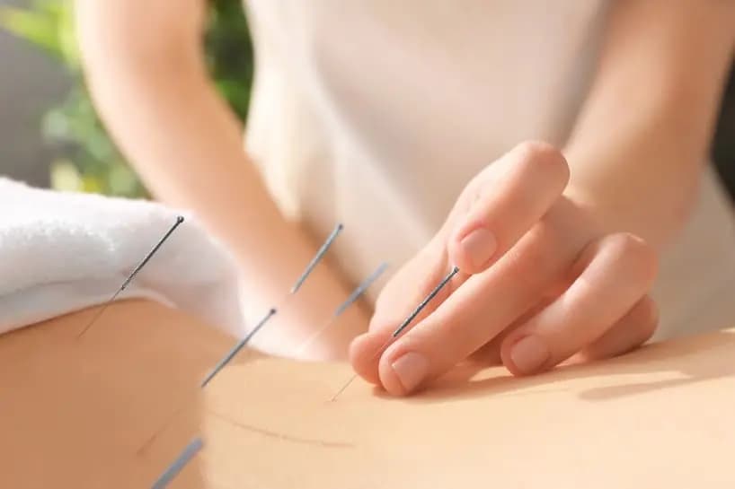 Akupunktur Behandlung am Rücken.